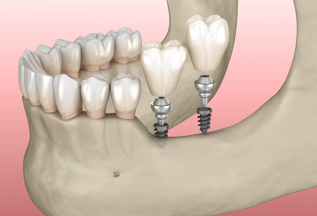 An Advanced Option When Bone Loss Rules Out Traditional Implants