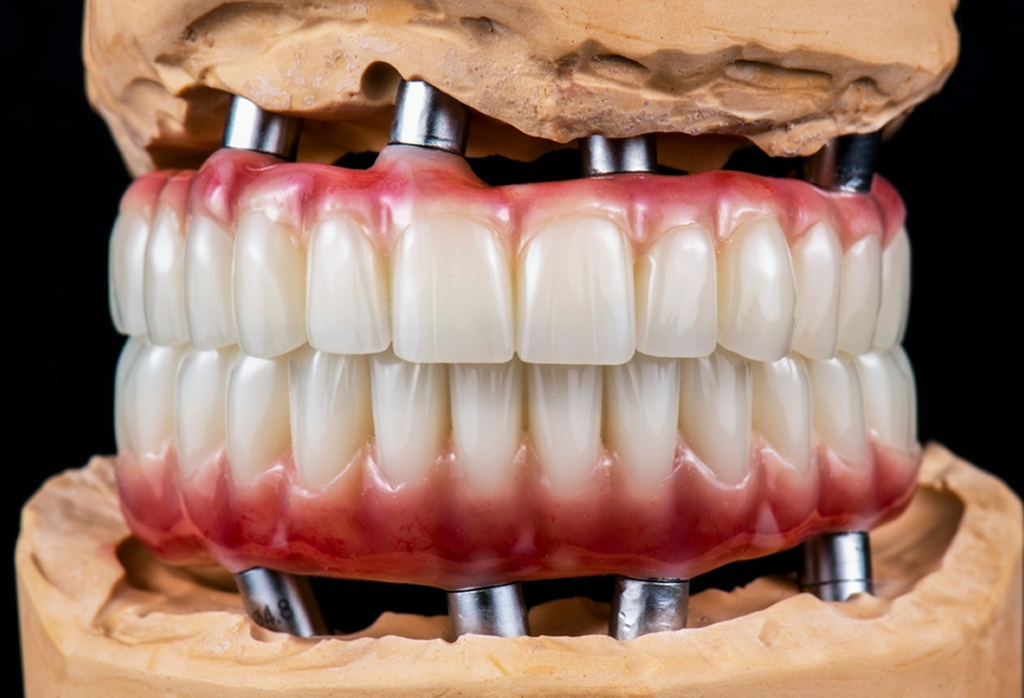A Full-Arch Solution Custom-Tailored to Your Anatomy