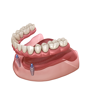 Zygomatic Dental Implants