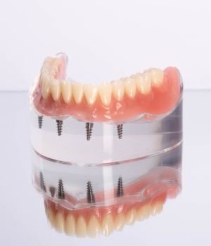 All-on-X Dental Implants