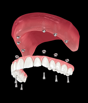 All-on-X Dental Implants