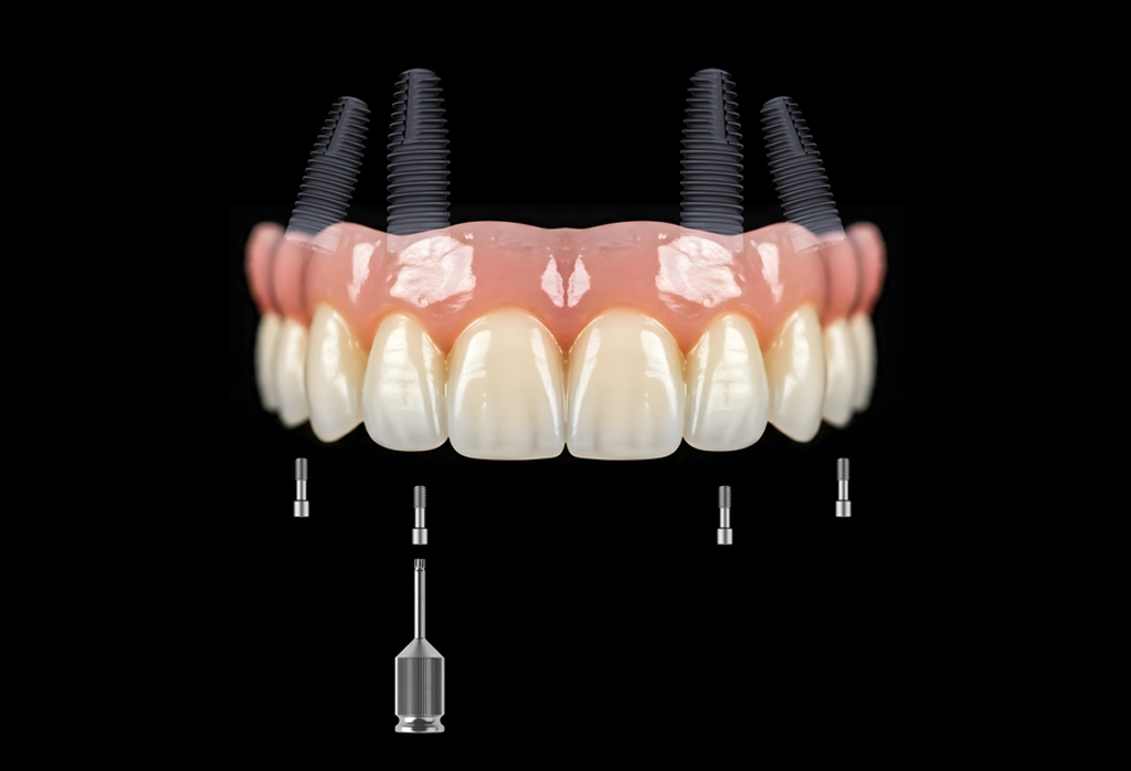 A Full-Arch Solution Custom-Tailored to Your Anatomy